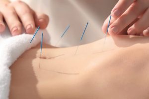 acupuntura y moxibustión para COVID-19